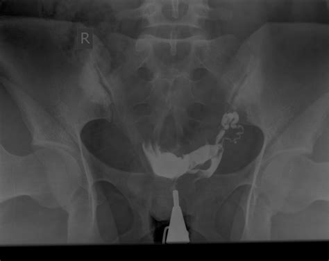 Unicornuate Uterus Image Radiopaedia Org