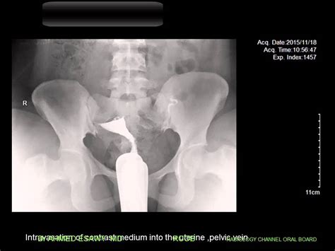 CASE 107 VENOUS INTRAVASATION HSG YouTube