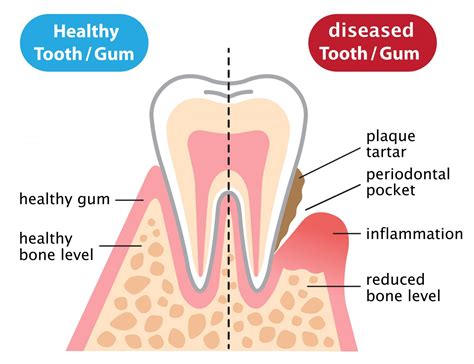 Types Of Periodontal Therapy Arizona Periodontal Group