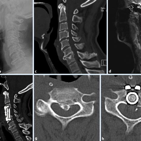 Pdf Cervical Posterior Longitudinal Ligament Ossification Microscopy