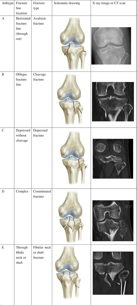 Establishment Of Classification Of Tibial Plateau Fracture Associated