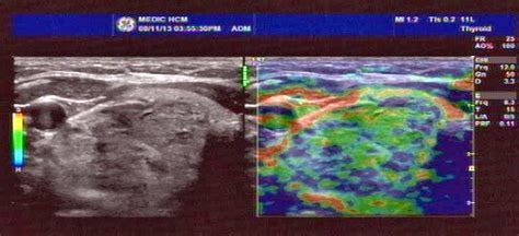 VIETNAMESE MEDIC ULTRASOUND: CASE 217: THYROID TUMOR, Dr PHAN THANH HẢI ...