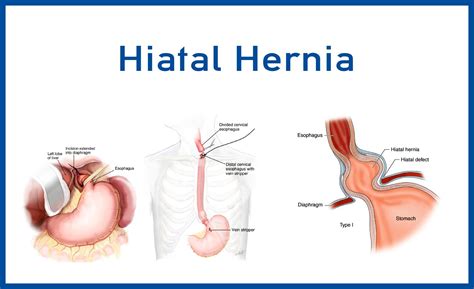 Hiatal Hernia Hiatal Hernia And Normal Anatomy Of The Stomach Stock