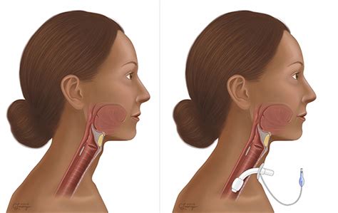 Traqueostomia Pdf Medicina Clinica Procedimiento M Dico Off