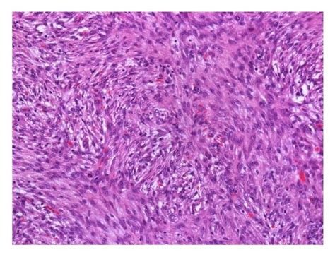 A Proliferation Of Spindle Cells Arranged In Fascicles Hematoxylin