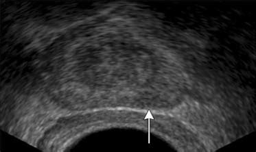 Prostate Cancer | Radiology Key