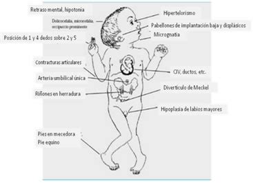 Sindrome De Edwards Bebe - Infogen | Síndrome de Edwards Trisomía 18