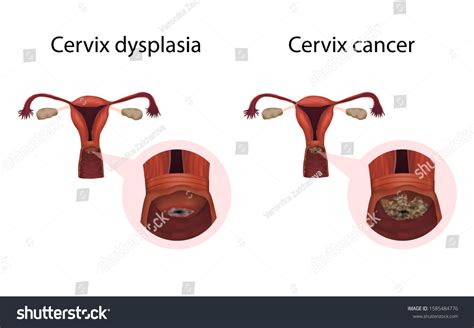 Cervix Dysplasia Cancer Cervical Disease Medical Stock Illustration