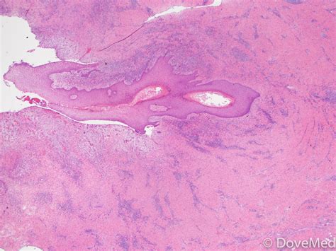 Stages Of Pilonidal Cyst