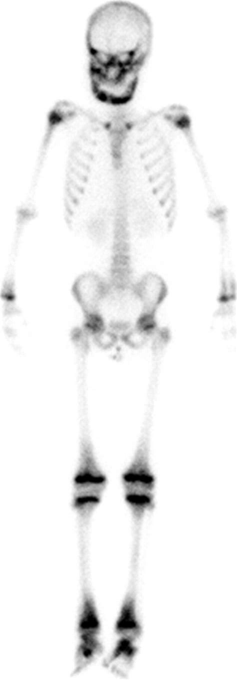 Imaging Of Chronic Recurrent Multifocal Osteomyelitis Radiographics