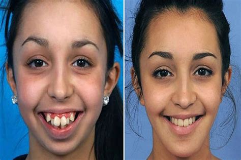 Clear Aligners Affect Your Facial Structure Sdalign Invisible Braces