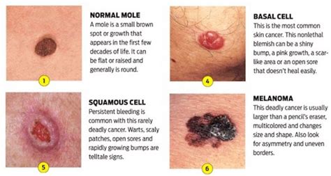 Warning Signs and Symptoms of Non-Melanoma Skin Cancer | Page 6 ...