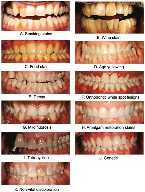 How to Whiten Teeth Naturally - Home Treatment Vs Professional Therapy