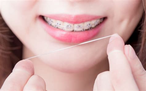 A Step by Step Helpful Guide to Flossing With Braces