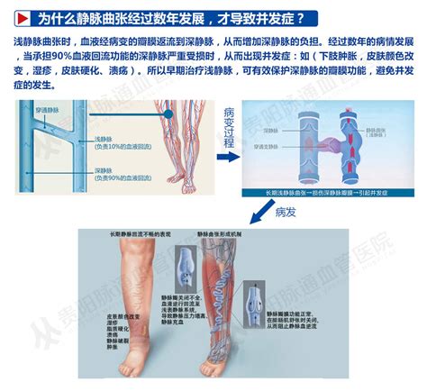 下肢静脉曲张的危险因素有哪些贵阳脉通血管外科医院好吗 哔哩哔哩