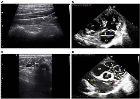 Frontiers Case Report Thromboembolic Heartworm Induced Lower Limb