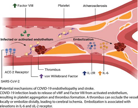 Ischemic Stroke Inflammation And Endotheliopathy In COVID 19 Patients