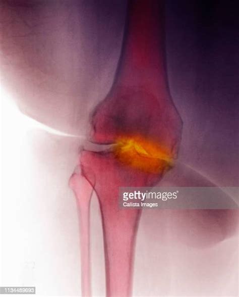 Degenerative Knee Photos And Premium High Res Pictures Getty Images