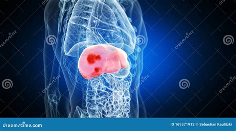 Liver Tumors Stock Illustration Illustration Of Accurate 169371912