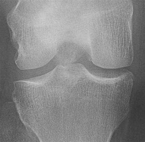 Detection Of Osteophytes And Subchondral Cysts In The Knee With Use Of Tomosynthesis Radiology