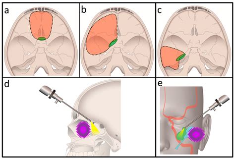 Current Oncology Free Full Text Combined Exoscopic And Endoscopic