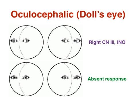 Emergency In Neurology