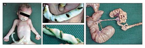 Figure From Familial Apple Peel Jejunal Atresia With Helical