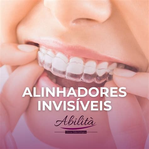 Alinhadores Invisíveis SouSmile em Brasília DF