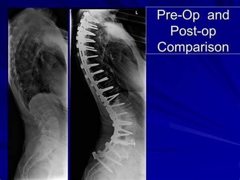 Case Review 11 Adult Idiopathic Scoliosis Ppt