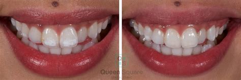 Icon White Spot Removal Bristol Queen Square Dental Clinic