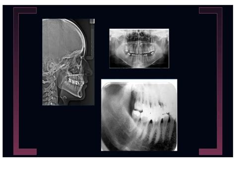 Radiografias Intraorales Y Extraoral Odontologia Ppt