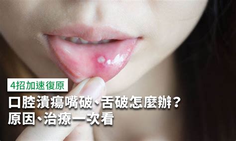 口腔潰瘍怎麼辦？多久會好？口腔潰瘍原因、治療一次看 康健雜誌