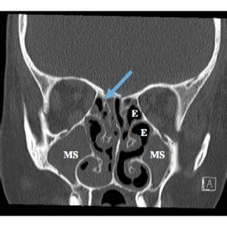 CT scan of the paranasal sinuses showing complete opacification of the ...