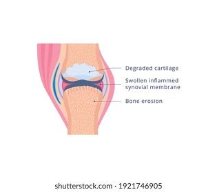 Medical Diagram Knee Joint Damaged By Stock Vector (Royalty Free ...