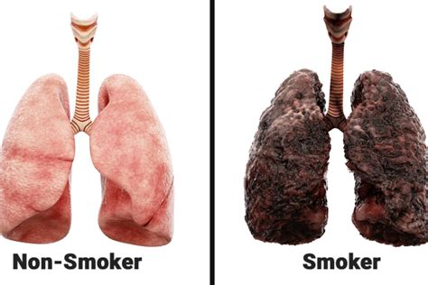 Smoking Lungs Before And After