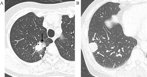 Computed Tomography Ct Findings Of Primary Lung Cancer Lc And