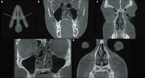 Nasal Airway Obstruction And Orofacial Pain