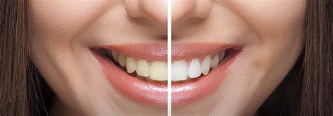 Teeth Whitening Brighten Your Smile Safely Effectively The Sinus Lift