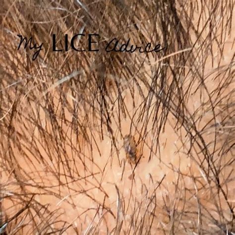 Black Lice and Lice in Black Hair (with Pictures) - My Lice Advice