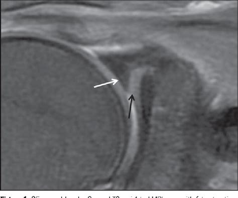 Mri Shoulder Labrum Tear