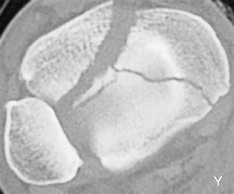 Anatomy Of Pilon Fractures Of The Distal Tibia Bone And Joint