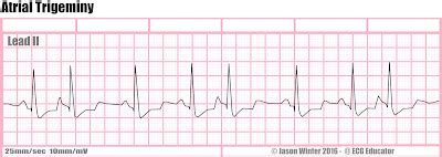 ECG Educator Blog : Six Second ECG Rhythm Strips