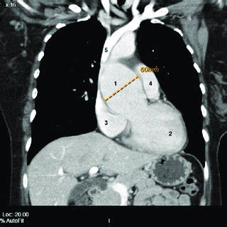 Chest CT With Contrast Coronary View Demonstrates The 1 60 Mm