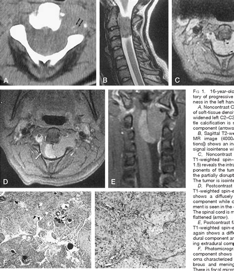 Pdf Cervical Spinal Meningioma With Unusual Mr Contrast Enhancement