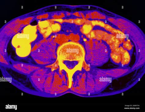 Human Abdomen Coloured Computed Tomography Ct Scan Of An Axial