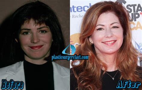 Dana Delany Plastic Surgery Before and After Photos