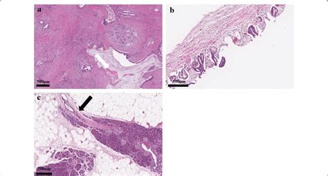 Microscopic Findings Of Resected Specimens A The Tumor Was Composed Of