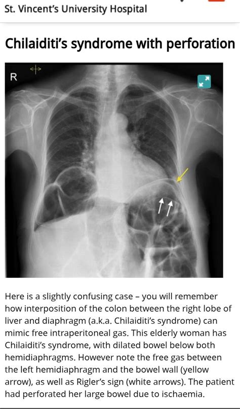 Sthanu On Twitter Chilaiditis Syndrome Chilaiditi S Sign Describes