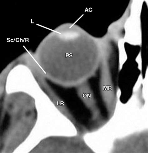 Injuries Of The Globe What Can The Radiologist Offer Radiographics