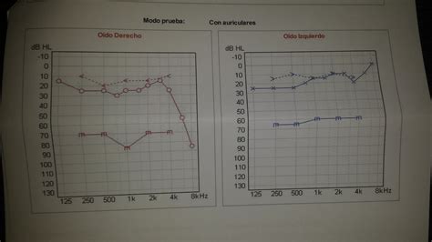 Niveles De Audiometrias Normales